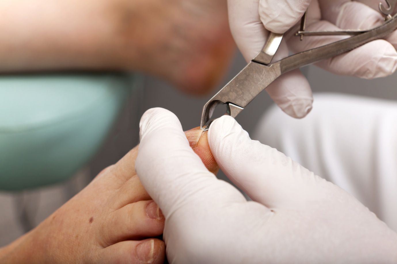 A picture of a foot undergoing a Nail Surgery treatment. Cranstoun Footcare in East Linton, specialise in Nail Surgery